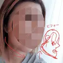 あごプロテーゼ / 骨削り（エラ） / 骨削り（頬） GNG美容外科 DAY 90 サムネイル用