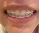 矯正（ワイヤー） ルーセント歯科・矯正歯科 DAY 338 サムネイル用