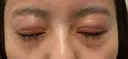 二重切開 / 眼瞼下垂（切開） / 目尻切開 / 上まぶたの脂肪取り / タレ目形成・グラマラスライン（切開） id（アイディ）美容外科 DAY 29 サムネイル用
