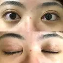 二重切開 / 目頭切開 / ほくろ・いぼ切除（肌） / 上まぶたたるみ取り / 上まぶたの脂肪取り 東京美容外科 銀座院 AFTER サムネイル用