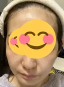 骨削り（頬） RG整形外科（旧リオン整形外科） DAY 26 サムネイル用