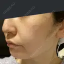 骨削り（頬） RG整形外科（旧リオン整形外科） DAY 26 サムネイル用