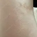 脂肪吸引（脚） 宇都宮竹内クリニック DAY 14 サムネイル用