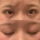 二重切開 大阪梅田中央クリニック美容外科 AFTER サムネイル用