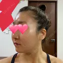 骨切り（あご） / 骨削り（エラ） / 骨削り（頬） バノバギ整形外科 DAY 37 サムネイル用
