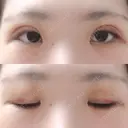 二重埋没 / 上まぶたの脂肪取り 湘南美容クリニック 京都院 DAY 6 サムネイル用
