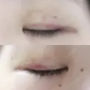 二重埋没 / 上まぶたの脂肪取り 湘南美容クリニック 京都院 DAY 6 サムネイル用