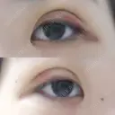 二重埋没 / 上まぶたの脂肪取り 湘南美容クリニック 京都院 DAY 6 サムネイル用