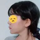 糸リフト / 脂肪吸引（顔） / その他（肌） ビューティーライン美容外科 DAY 24 サムネイル用