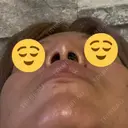 隆鼻術 品川美容外科 名古屋院 DAY 11 サムネイル用