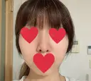 隆鼻術 / 鼻尖形成（切開） / 軟骨移植 湘南美容クリニック 名古屋栄院 AFTER サムネイル用