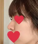 隆鼻術 / 鼻尖形成（切開） / 軟骨移植 湘南美容クリニック 名古屋栄院 DAY 73 サムネイル用