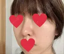 隆鼻術 / 鼻尖形成（切開） / 軟骨移植 湘南美容クリニック 名古屋栄院 DAY 73 サムネイル用