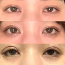 眼瞼下垂（切開） / 目尻切開 / タレ目形成・グラマラスライン（切開） プロミス整形外科 DAY 36 サムネイル用