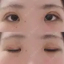 二重埋没 / 上まぶたの脂肪取り 湘南美容クリニック 京都院 AFTER サムネイル用