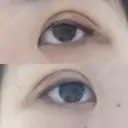 二重埋没 / 上まぶたの脂肪取り 湘南美容クリニック 京都院 DAY 7 サムネイル用