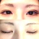 眼瞼下垂（切開） / その他（肌） La Clinique Shinjuku 【ラクリニック 新宿】 DAY 0 サムネイル用
