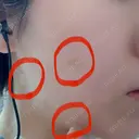 ほくろ・いぼ切除（肌） 赤坂メディカルMクリニック DAY 0 サムネイル用