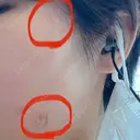 ほくろ・いぼ切除（肌） 赤坂メディカルMクリニック DAY 0 サムネイル用