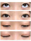 二重切開 / 上まぶたたるみ取り / 上まぶたの脂肪取り / 目元修正 リビジョンクリニック（旧：池本形成外科・美容外科） DAY 105 サムネイル用