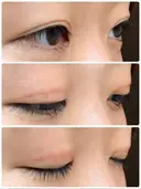 二重切開 / 上まぶたたるみ取り / 上まぶたの脂肪取り / 目元修正 リビジョンクリニック（旧：池本形成外科・美容外科） DAY 105 サムネイル用