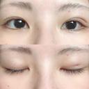 眼瞼下垂（切開） / その他（肌） La Clinique Shinjuku 【ラクリニック 新宿】 DAY 2 サムネイル用