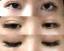 二重埋没 / 目頭切開 / 眼瞼下垂（切開） / 目尻切開 グロービー美容整形外科 DAY 137 サムネイル用