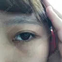 下まぶたたるみ取り セオリークリニック DAY 14 サムネイル用