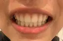 矯正（ワイヤー） ルーセント歯科・矯正歯科 AFTER サムネイル用