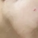 ほくろ・いぼ切除（肌） 赤坂メディカルMクリニック DAY 2 サムネイル用