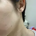 ほくろ・いぼ切除（肌） 赤坂メディカルMクリニック DAY 2 サムネイル用