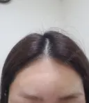 肌ヒアルロン酸注入（たるみ・シワ改善） 表参道スキンクリニック 表参道院 DAY 1 サムネイル用