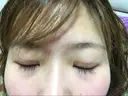 眼瞼下垂（切開） 芦屋美容クリニック 芦屋院 DAY 33 サムネイル用