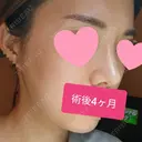あごプロテーゼ / 骨削り（エラ） / 骨削り（頬） GNG美容外科 DAY 122 サムネイル用
