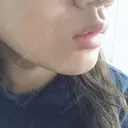 ボトックス（口角） 湘南美容クリニック 浜松院 DAY 2 サムネイル用