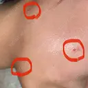 ほくろ・いぼ切除（肌） 赤坂メディカルMクリニック DAY 6 サムネイル用