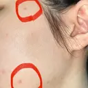 ほくろ・いぼ切除（肌） 赤坂メディカルMクリニック DAY 6 サムネイル用