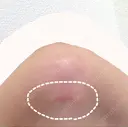 糸リフト / 脂肪吸引（顔） / その他（輪郭） / 切開リフト 清潭清楚整形外科 DAY 63 サムネイル用