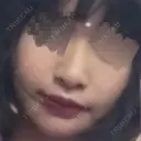 人中短縮 / 口角挙上 ドクターゴールドマンクリニック 東京高輪院 DAY 40 サムネイル用