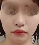 人中短縮 / 口角挙上 ドクターゴールドマンクリニック 東京高輪院 DAY 40 サムネイル用