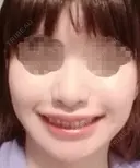 人中短縮 / 口角挙上 ドクターゴールドマンクリニック 東京高輪院 DAY 53 サムネイル用