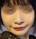 人中短縮 / 口角挙上 ドクターゴールドマンクリニック 東京高輪院 DAY 150 サムネイル用