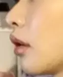 人中短縮 / 口角挙上 ドクターゴールドマンクリニック 東京高輪院 DAY 150 サムネイル用