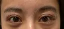 二重切開 / 眼瞼下垂（切開） / 目尻切開 / 上まぶたの脂肪取り / タレ目形成・グラマラスライン（切開） id（アイディ）美容外科 AFTER サムネイル用