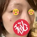 シミ取りレーザー / ルビーレーザー TOKUNAKAクリニック表参道本院 DAY 5 サムネイル用