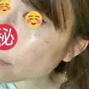 シミ取りレーザー / ルビーレーザー TOKUNAKAクリニック表参道本院 DAY 5 サムネイル用