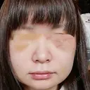 骨削り（頬） / 脂肪注入（肌） ボンディ美容整形外科（旧リオン整形外科） DAY 4 サムネイル用