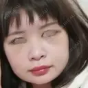 骨削り（頬） / 脂肪注入（肌） ボンディ美容整形外科（旧リオン整形外科） DAY 4 サムネイル用