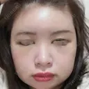 骨削り（頬） / 脂肪注入（肌） ボンディ美容整形外科（旧リオン整形外科） DAY 5 サムネイル用