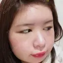 骨削り（頬） / 脂肪注入（肌） ボンディ美容整形外科（旧リオン整形外科） DAY 5 サムネイル用